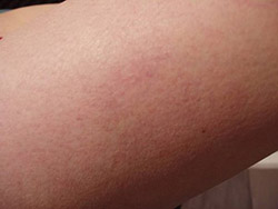 Traitement de la couperose par laser cas 1 après