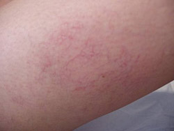 Traitement de la couperose par laser cas 1 avant