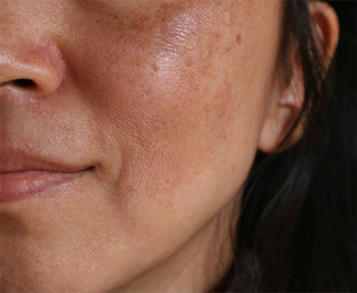 Comment traiter et prévenir les taches brunes sur la peau ?